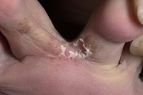 příznaky plísní na nohou