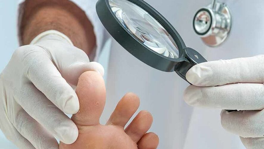 Diagnózu plísně nehtů na nohou provádí dermatolog