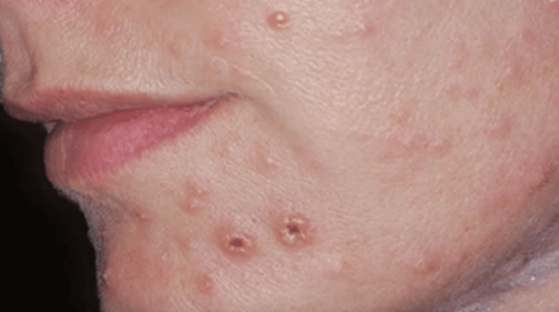Plísňová infekce kůže na obličeji