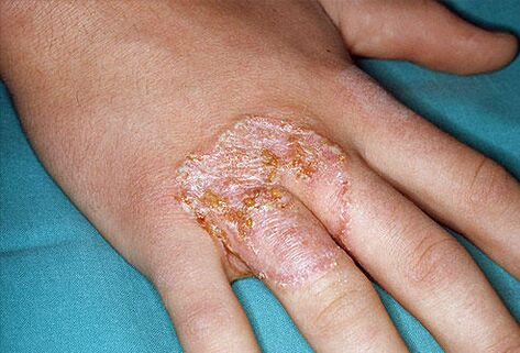 Červené skvrny ve tvaru náhrdelníku na kůži rukou v důsledku mykózy